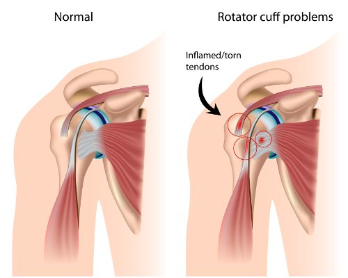 Shoulder physiotherapy in Hyderabad